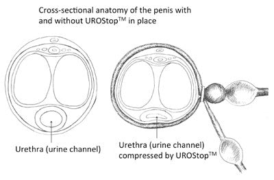 UroStop